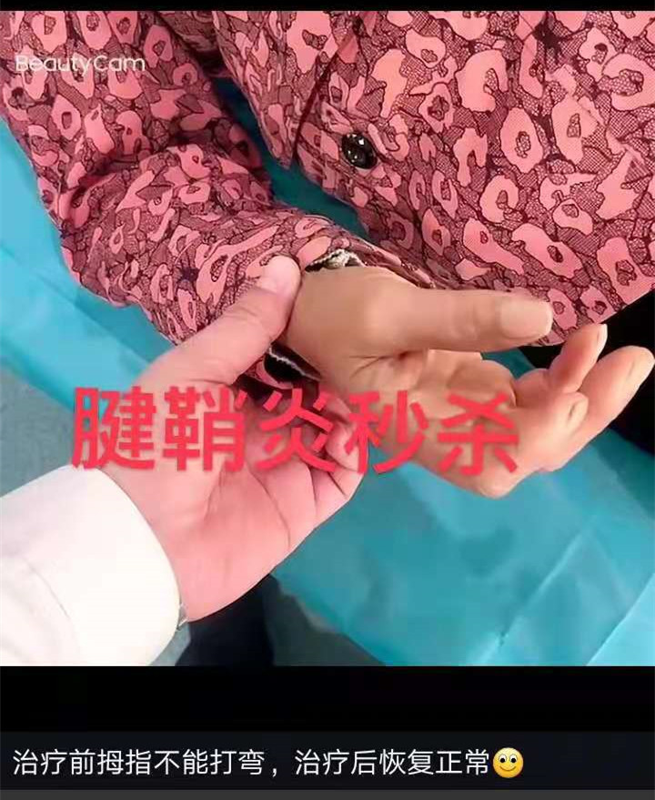案例五_腱鞘炎
